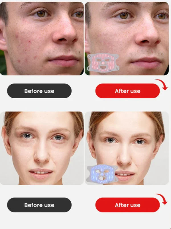Red & Blue Light Therapy Mask